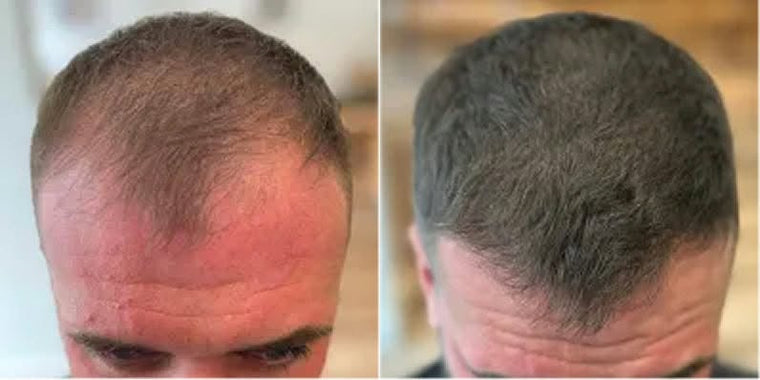 Michael M. before and after