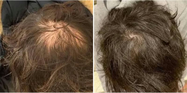 Tyler B. before and after